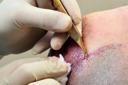 Turkey Hair Transplant