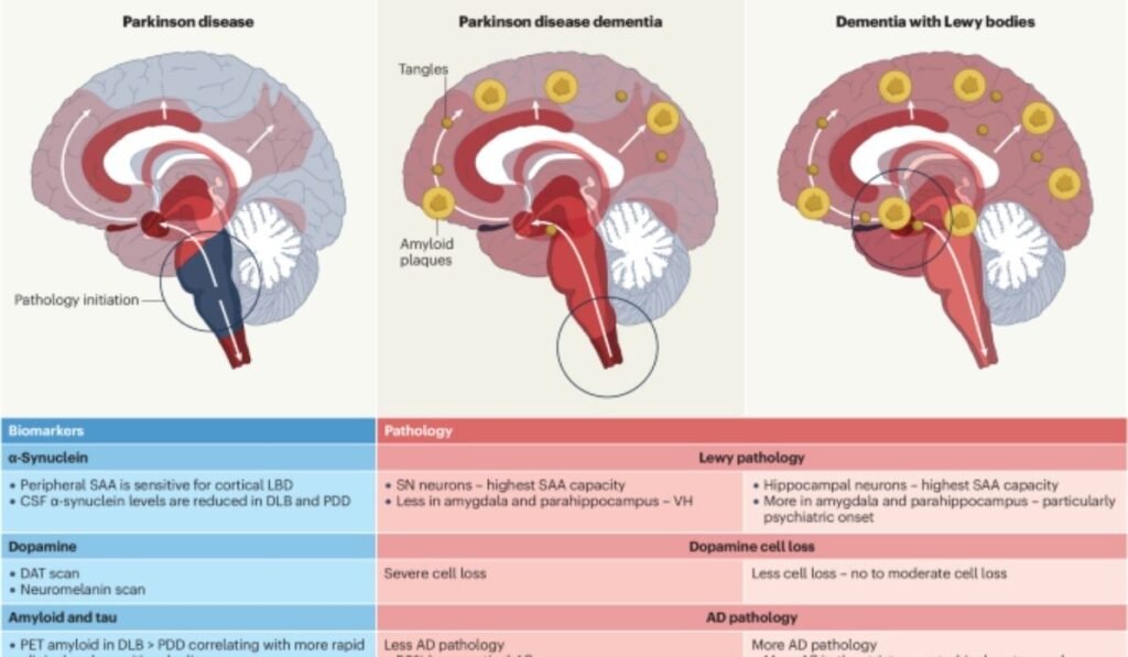 lewy body dementia